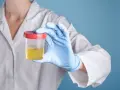 Ręka w niebieskiej rękawiczce trzyma pojemnik z żółtym płynem, potencjalnie badanie na obecność cukru w moczu.