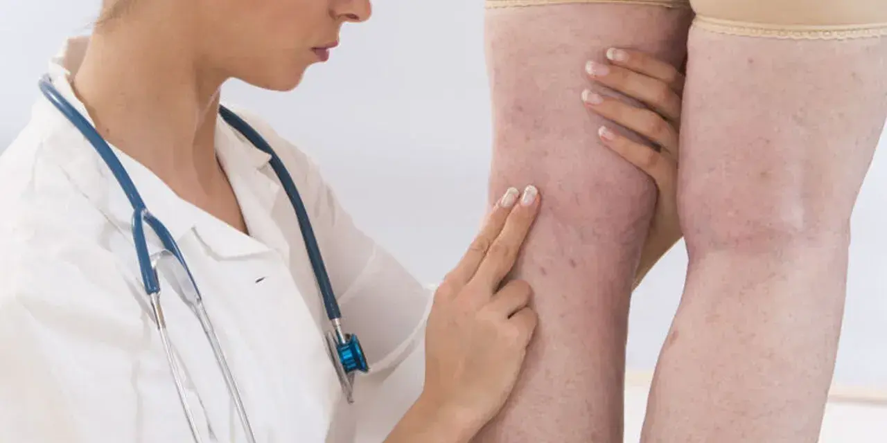 Lekarka bada nogi pacjentki z widocznymi żylakami. Wyniki badań wskazują na d-dimery 1500, co może sugerować zakrzepicę.