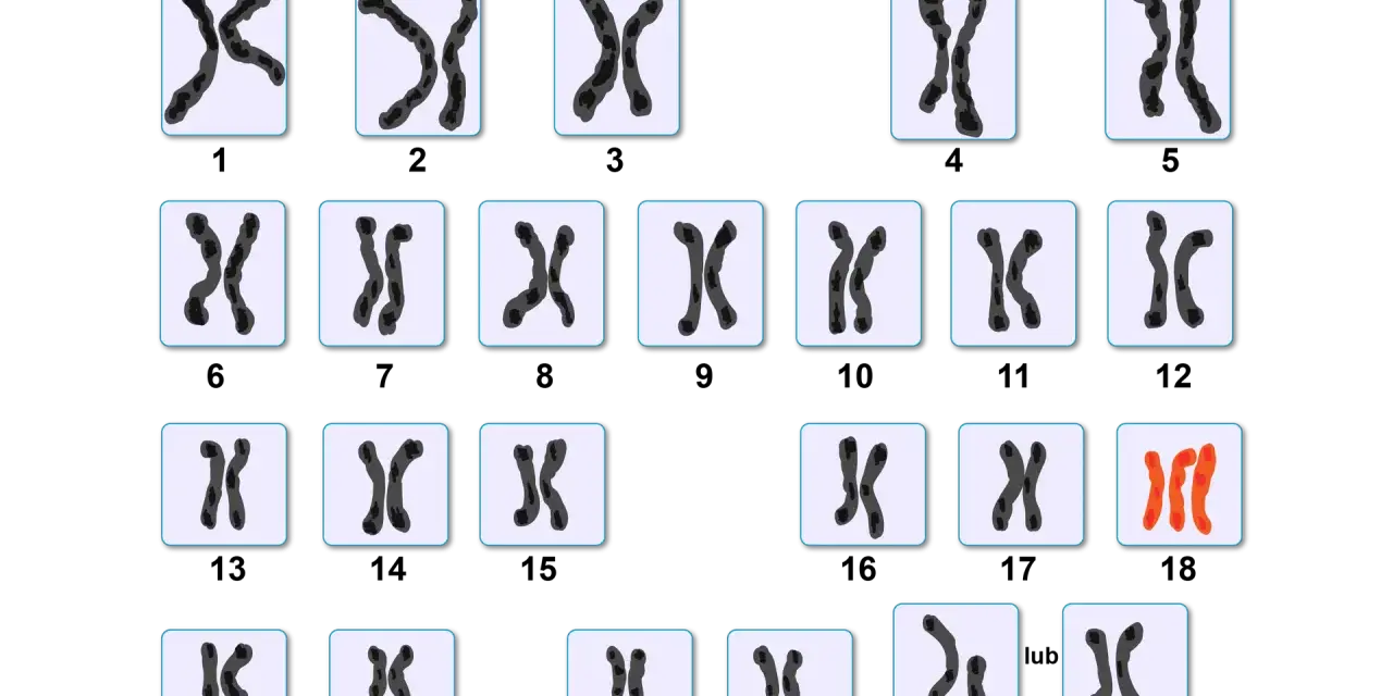 Kariotyp przedstawia pary chromosomów, w tym jedną parę w kolorze pomarańczowym, sugerującą anomalię.