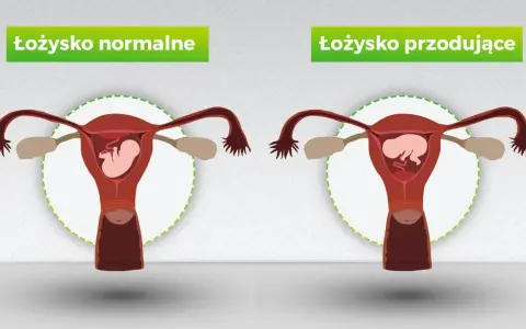 Porównanie: łożysko normalne vs łożysko przodujące. Po prawej stronie widoczna macica z płodem i łożyskiem przodującym, blokującym szyjkę macicy.
