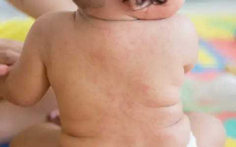 Plecy niemowlęcia pokryte drobną, czerwoną wysypką, przypominającą różyczkę. Mama martwi się o zdrowie maluszka.
