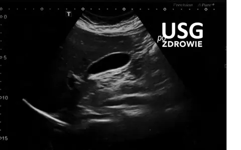 Obraz USG przedstawia pęcherzyk żółtkowy, ważny element układu trawiennego.