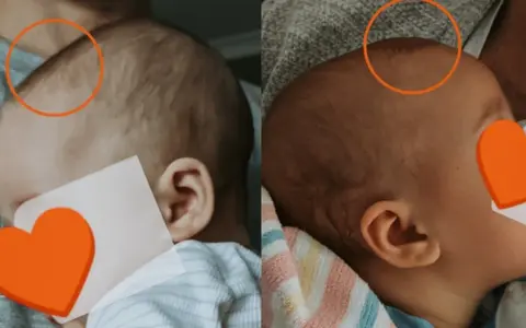 Porównanie główek niemowląt. Na lewym zdjęciu widoczne jest zapadnięte ciemiączko, na prawym jest ono bardziej wypukłe.