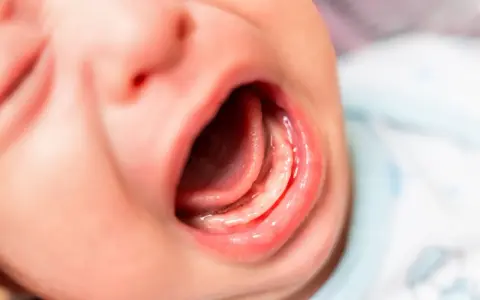 Usta niemowlaka z widocznym językiem i dziąsłami. Może to być związane z za krótkim wędzidełkiem u niemowlaka objawy.