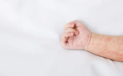 Różowa, nieswędząca wysypka u dziecka na białym tle. Skóra na rączce dziecka jest pokryta drobnymi, czerwonymi plamkami.