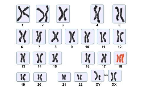 Kariotyp przedstawia pary chromosomów, w tym jedną parę w kolorze pomarańczowym, sugerującą anomalię.