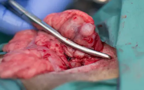 Chirurgiczne usuwanie torbieli na jajniku o średnicy 5 cm. Widoczne tkanki i narzędzia chirurgiczne.