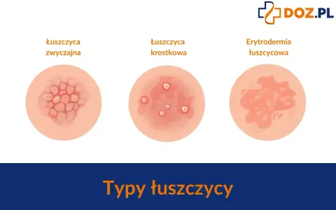 Ilustracje pokazują różne typy łuszczycy: zwyczajną, krostkową i erytrodermię łuszczycową. Ważne, by znać objawy łuszczycy u dzieci.