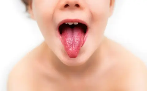 Język dziecka z wybroczynami, objaw szkarlatyny.