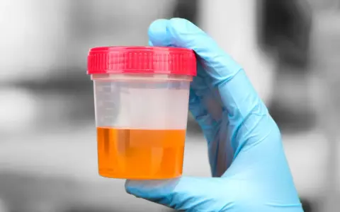 Rękawiczka w niebieskiej rękawiczce trzyma pojemnik z próbką moczu, która może wskazywać na bakterie w moczu u dziecka.