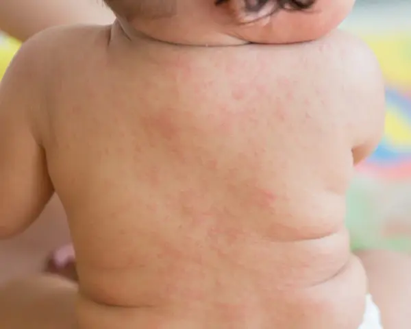 Plecy niemowlęcia pokryte drobną, czerwoną wysypką, przypominającą różyczkę. Mama martwi się o zdrowie maluszka.