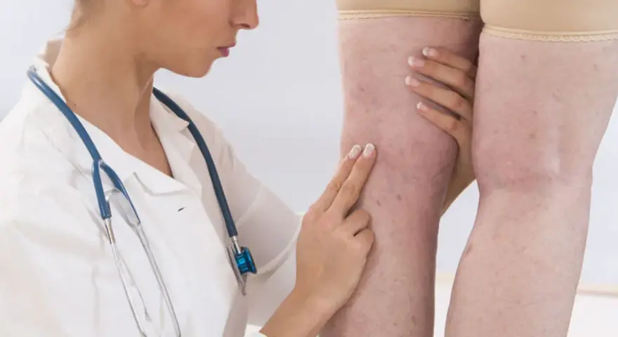 Lekarka bada nogi pacjentki z widocznymi żylakami. Wyniki badań wskazują na d-dimery 1500, co może sugerować zakrzepicę.