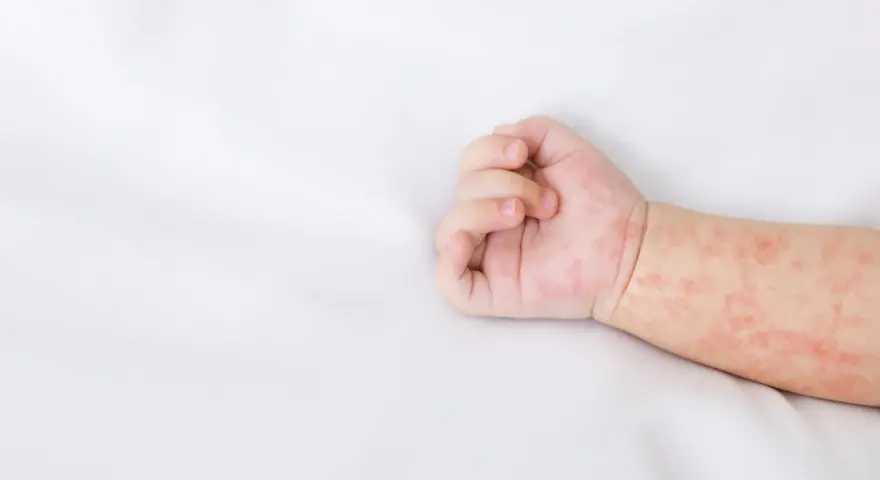 Różowa, nieswędząca wysypka u dziecka na białym tle. Skóra na rączce dziecka jest pokryta drobnymi, czerwonymi plamkami.