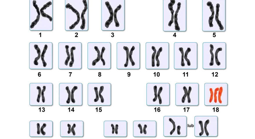 Kariotyp przedstawia pary chromosomów, w tym jedną parę w kolorze pomarańczowym, sugerującą anomalię.