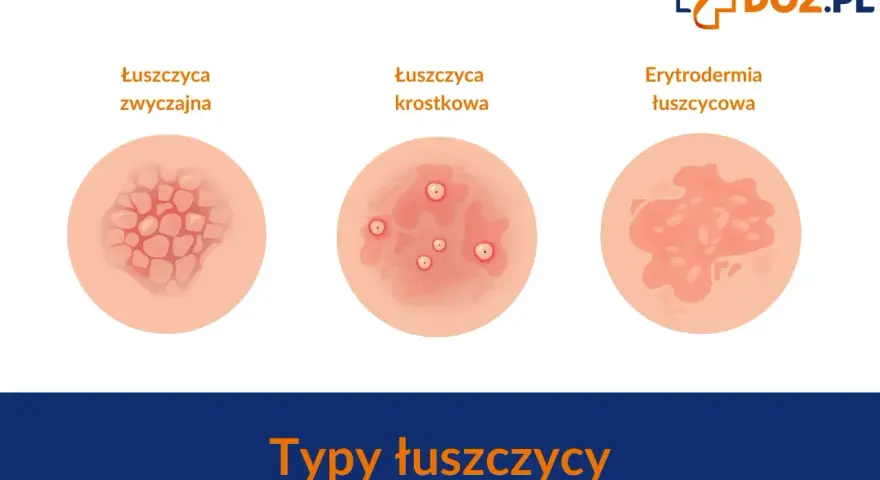 Ilustracje pokazują różne typy łuszczycy: zwyczajną, krostkową i erytrodermię łuszczycową. Ważne, by znać objawy łuszczycy u dzieci.
