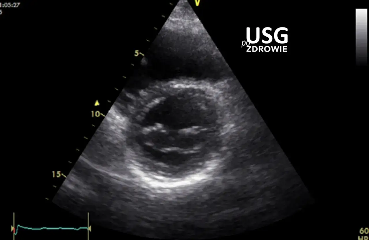 USG serca w ciąży, obraz przedstawia przekrój serca, może pomóc w diagnostyce kołatania serca w ciąży.