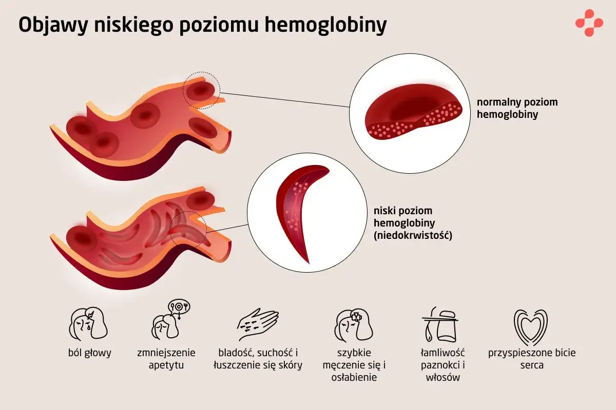 Niski poziom hemoglobiny objawia się bólem głowy, bladością, zmęczeniem i innymi symptomami. Ilustracja pokazuje różnicę między normalnymi a sierpowatymi krwinkami.