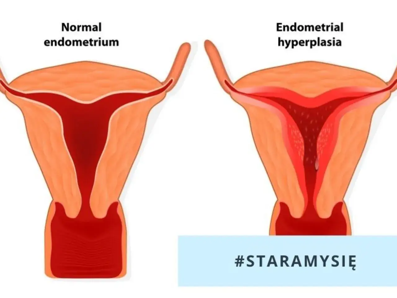 Porównanie budowy macicy: po lewej prawidłowe endometrium, po prawej przerost endometrium.