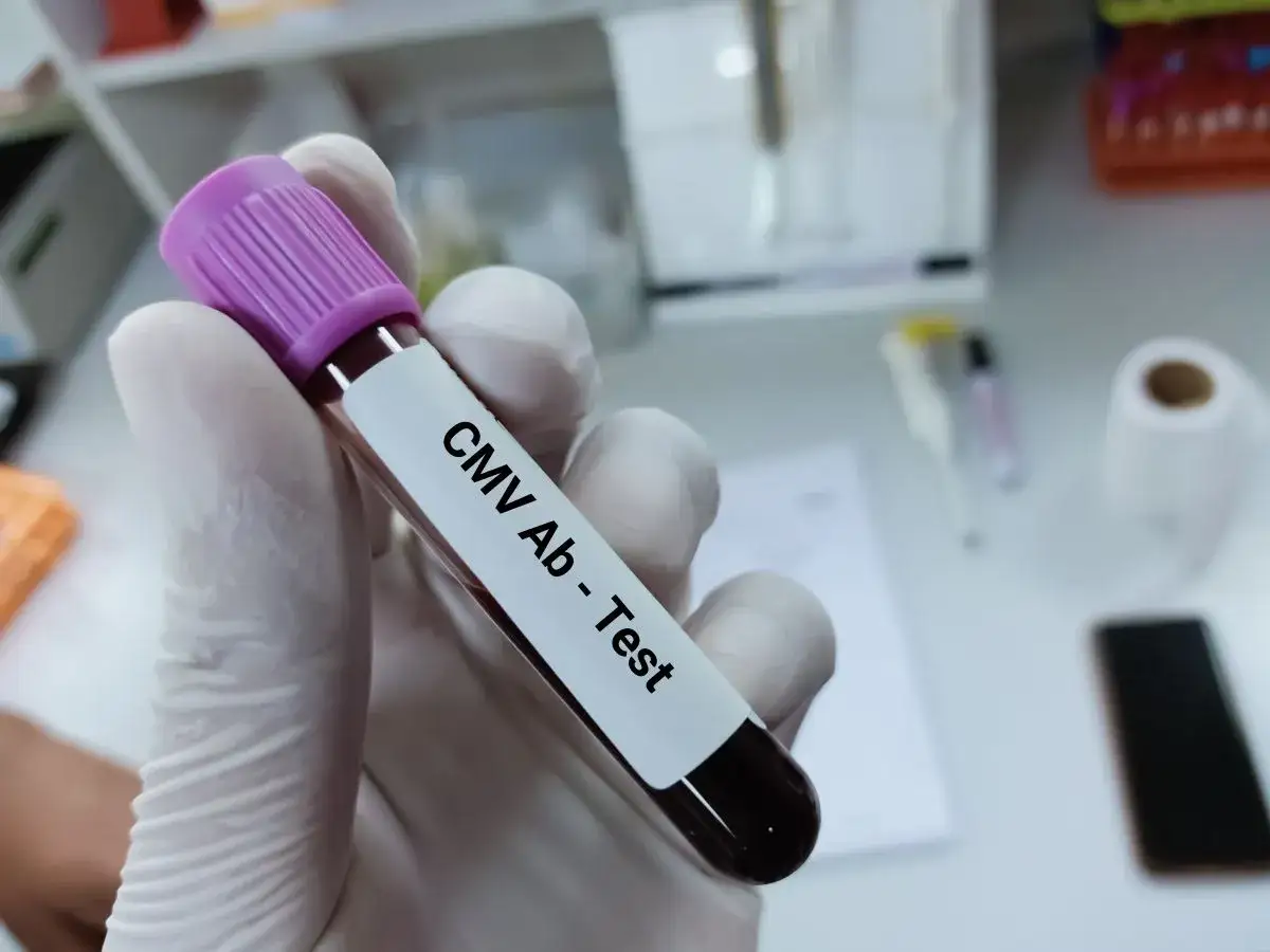 Rękawiczka trzyma probówkę z krwią do badania CMV IGG. Wynik dodatni w ciąży wymaga dalszej diagnostyki.